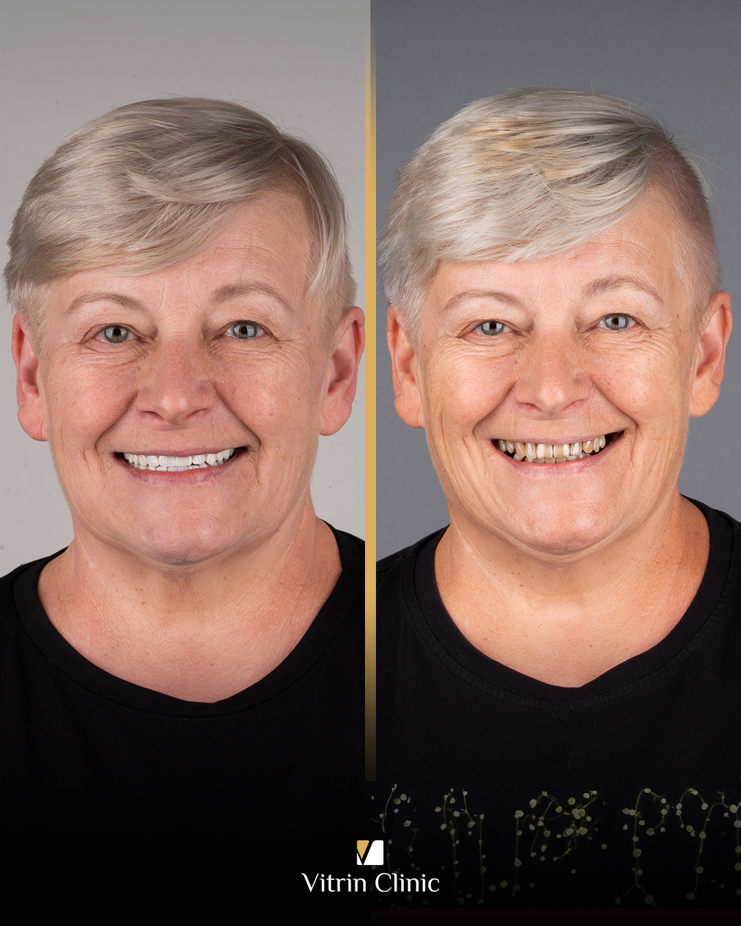 fixed retainers vs removable retainers